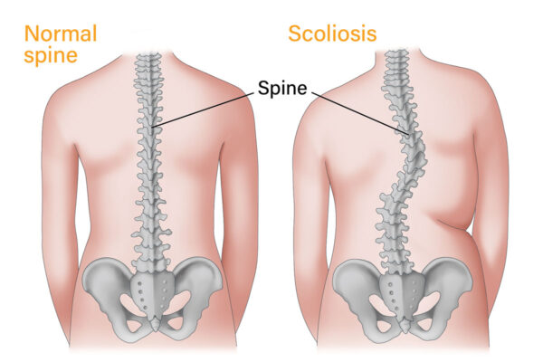 Scoliosis Treatment