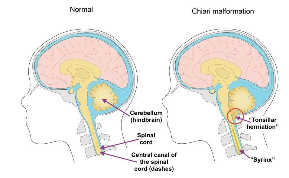Chiari Malformation Types
