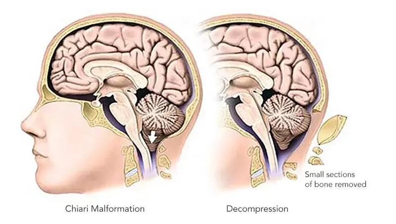 Chiari Malformation Surgery